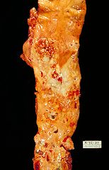 154px-Atherosclerosis,_aorta,_gross_pathology_PHIL_846_lores